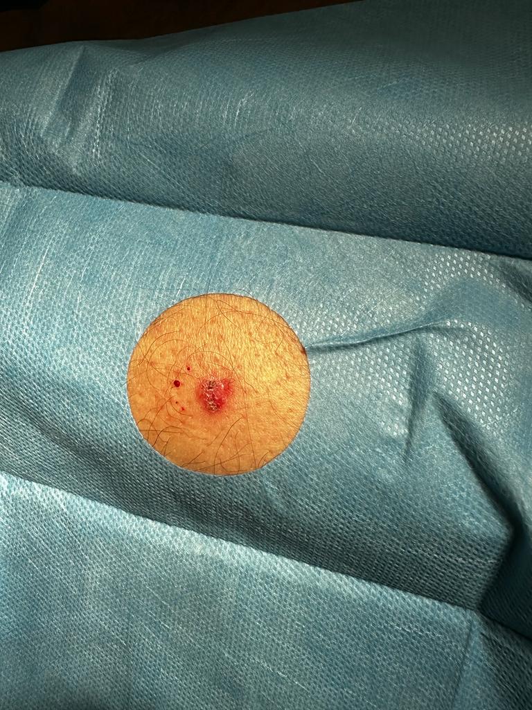 Nevi sulla gamba intervento Asportazione e eredi neoformazione sulla coscia possibile epitelioma controllo istologico per convalidare