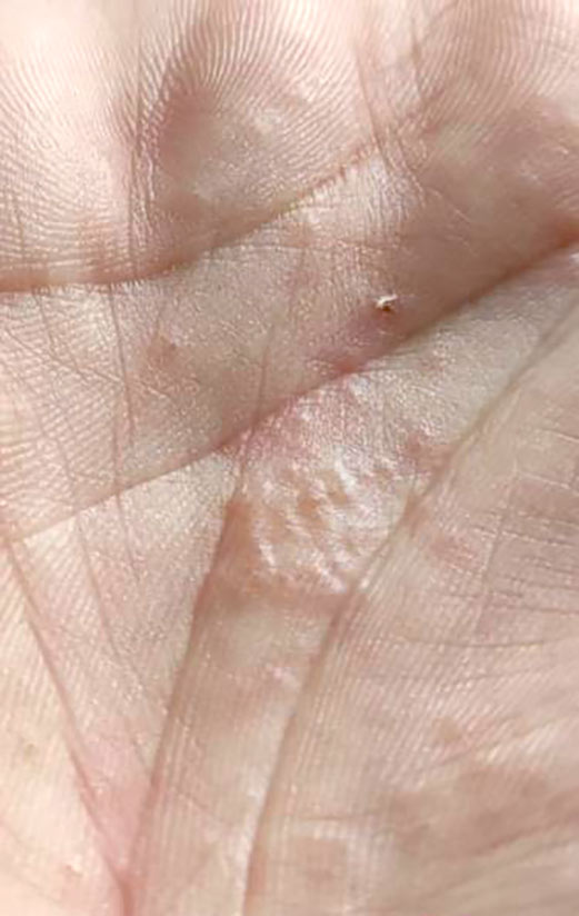 Manifestazione visiva dell'acaro della scabbia