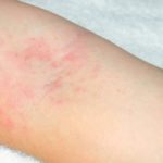 Eczema: quelle fastidiose macchie rosse sulla pelle cosa sono e come guariscono?