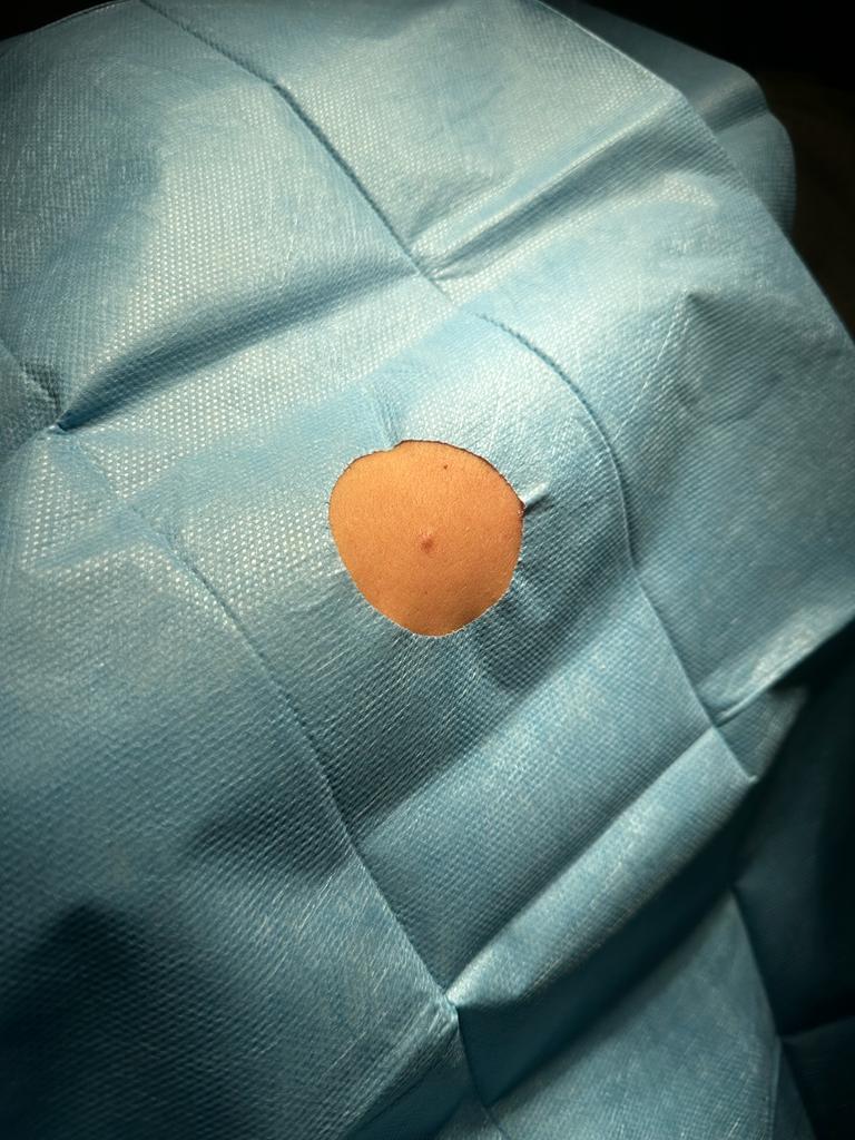 sospetto Dermatofibroma