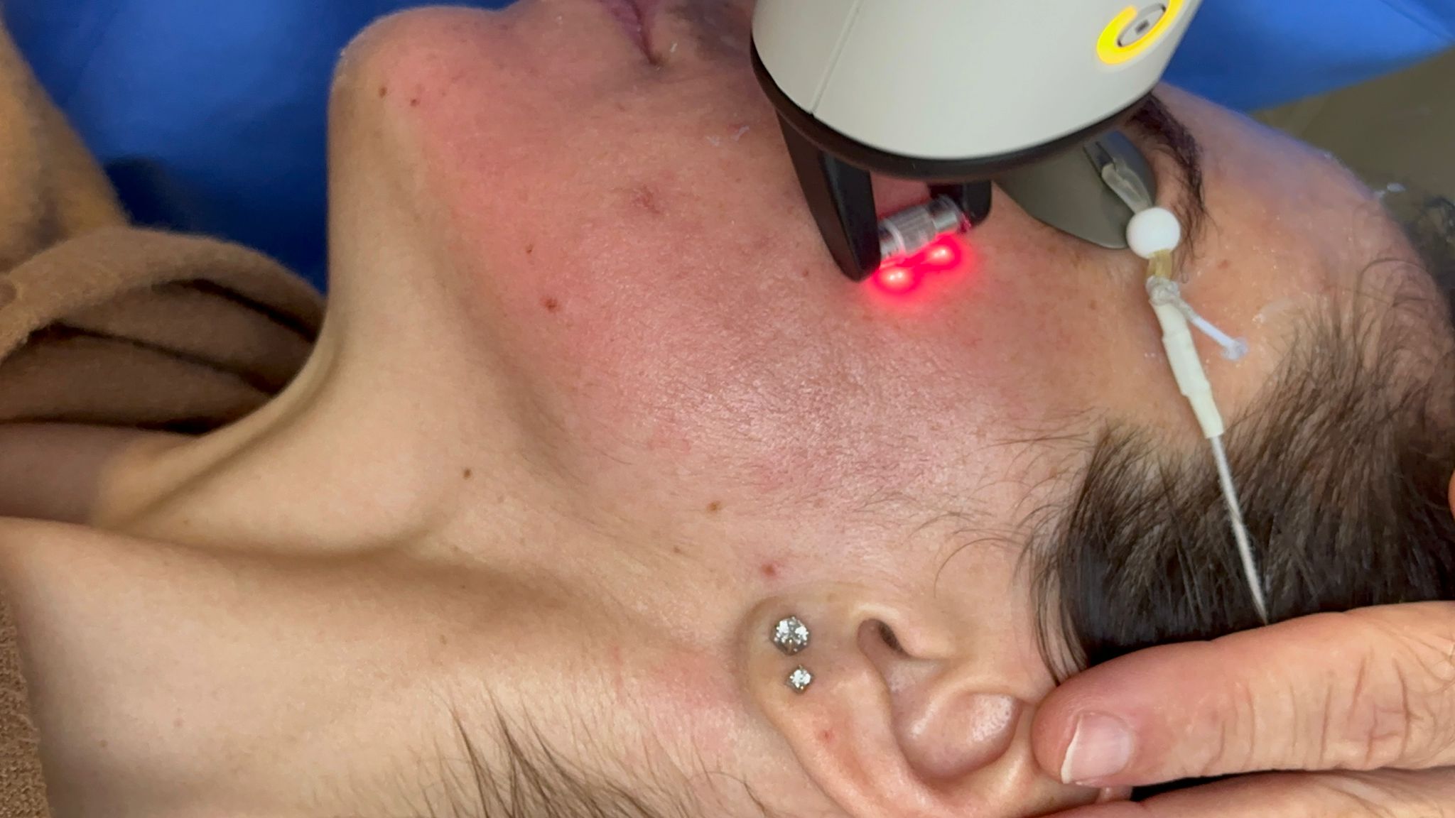 trattamenti dermatologici laser a Milano: Istituto IDE