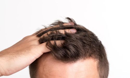 Trapianto dei capelli: diverse possibilità per la tua chioma