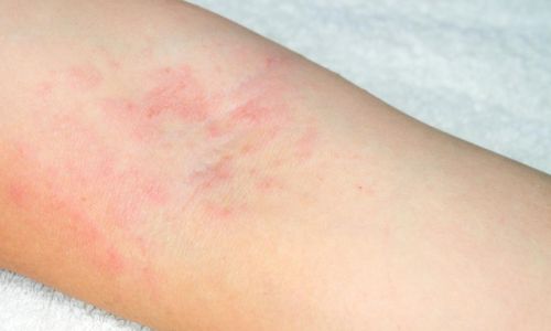 Eczema: come riconoscerlo e curarlo a Milano
