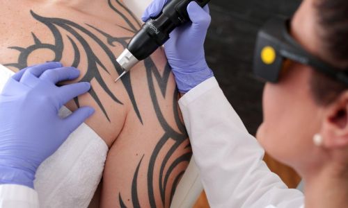 Rimozione tatuaggi con laser Milano