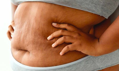 Trattamenti delle smagliature della pelle