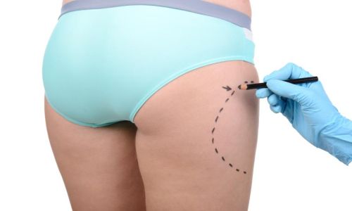 Liposuzione, liposcultura e addominoplastica a Milano presso IDE.