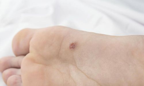 Come riconoscere e trattare le verruche - IDE Milano